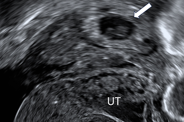 Fallopian Tube Abnormalities on Ultrasound | Article | GLOWM